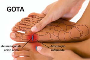 Gota (A Doença dos Reis): Por que a Dor é Tão Intensa e Como Tratar em Sorocaba