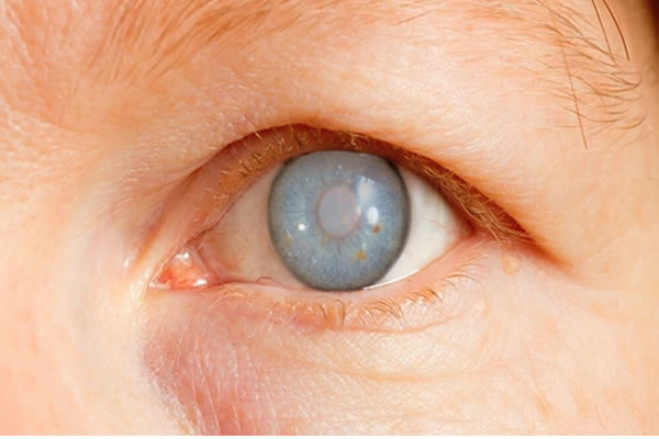 Tratamento de Glaucoma pelo plano de saúde Sorocaba