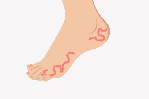 Bicho geográfico: como cuidar? Bicho geográfico: como cuidar?