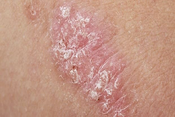 Psoríase: o que é e como tratar